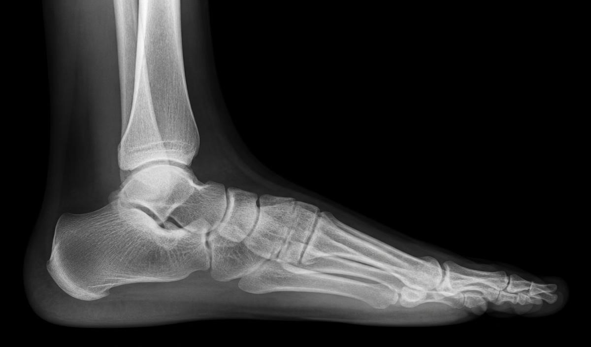 Foot and ankle radiograph used in FRCR Part 1 anatomy questions